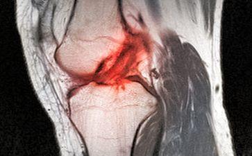 跑步后膝盖疼痛怎么办半月板损伤跑步后膝盖疼痛怎么办